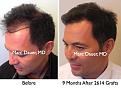 Click image for larger version

Name:	Hair Transplant Slides5.214.jpg
Views:	836
Size:	79.4 KB
ID:	467857