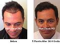 Click image for larger version

Name:	Hair Transplant Slides5.213.jpg
Views:	2211
Size:	69.8 KB
ID:	467858