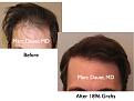 Click image for larger version

Name:	Hair Transplant Slides4.230.jpg
Views:	365
Size:	58.2 KB
ID:	467863