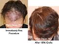 Click image for larger version

Name:	Hair Transplant Slides4.231.jpg
Views:	360
Size:	91.3 KB
ID:	467864