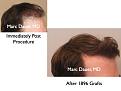 Click image for larger version

Name:	Hair Transplant Slides4.232.jpg
Views:	339
Size:	56.8 KB
ID:	467865