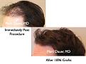 Click image for larger version

Name:	Hair Transplant Slides4.233.jpg
Views:	531
Size:	58.8 KB
ID:	467866