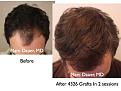 Click image for larger version

Name:	Hair Transplant Slides2.234.jpg
Views:	417
Size:	70.1 KB
ID:	467873