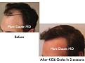 Click image for larger version

Name:	Hair Transplant Slides2.235.jpg
Views:	314
Size:	56.7 KB
ID:	467874
