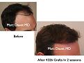 Click image for larger version

Name:	Hair Transplant Slides2.236.jpg
Views:	400
Size:	54.7 KB
ID:	467875