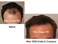 Click image for larger version

Name:	Hair Transplant Slides2.237.jpg
Views:	335
Size:	58.0 KB
ID:	467876