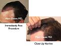 Click image for larger version

Name:	Hair Transplant Slides2.238.jpg
Views:	403
Size:	65.5 KB
ID:	467877