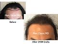 Click image for larger version

Name:	Hair Transplant Slides1.239.jpg
Views:	292
Size:	62.9 KB
ID:	467878