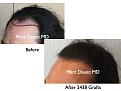 Click image for larger version

Name:	Hair Transplant Slides1.240.jpg
Views:	378
Size:	65.3 KB
ID:	467879