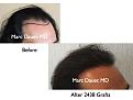 Click image for larger version

Name:	Hair Transplant Slides1.241.jpg
Views:	282
Size:	60.3 KB
ID:	467880