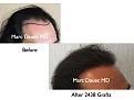 Click image for larger version

Name:	Hair Transplant Slides1.241.jpg
Views:	365
Size:	60.3 KB
ID:	467880