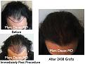 Click image for larger version

Name:	Hair Transplant Slides1.242.jpg
Views:	396
Size:	84.1 KB
ID:	467881