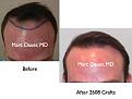 Click image for larger version

Name:	Hair Transplant Slides2.244.jpg
Views:	352
Size:	57.0 KB
ID:	468018