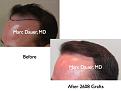 Click image for larger version

Name:	Hair Transplant Slides2.245.jpg
Views:	346
Size:	54.1 KB
ID:	468019