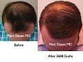 Click image for larger version

Name:	Hair Transplant Slides2.247.jpg
Views:	360
Size:	73.6 KB
ID:	468021