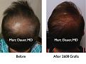 Click image for larger version

Name:	Hair Transplant Slides2.248.jpg
Views:	350
Size:	74.0 KB
ID:	468022