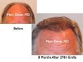 Click image for larger version

Name:	Hair Transplant Slides1.249.jpg
Views:	282
Size:	67.2 KB
ID:	468049