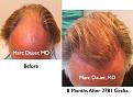 Click image for larger version

Name:	Hair Transplant Slides1.250.jpg
Views:	312
Size:	86.1 KB
ID:	468050