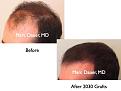 Click image for larger version

Name:	Hair Transplant Slides7.253.jpg
Views:	389
Size:	50.9 KB
ID:	468060