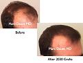 Click image for larger version

Name:	Hair Transplant Slides7.252.jpg
Views:	387
Size:	55.1 KB
ID:	468061