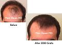 Click image for larger version

Name:	Hair Transplant Slides7.251.jpg
Views:	390
Size:	60.3 KB
ID:	468062