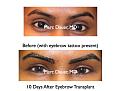 Click image for larger version

Name:	Hair Transplant Slides.255.jpg
Views:	497
Size:	71.3 KB
ID:	468151