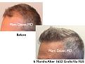Click image for larger version

Name:	Hair Transplant Slides9.258.jpg
Views:	450
Size:	74.2 KB
ID:	468213
