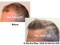 Click image for larger version

Name:	Hair Transplant Slides9.258.jpg
Views:	548
Size:	74.2 KB
ID:	468213