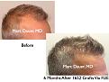 Click image for larger version

Name:	Hair Transplant Slides9.259.jpg
Views:	490
Size:	74.5 KB
ID:	468214