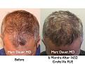 Click image for larger version

Name:	Hair Transplant Slides9.260.jpg
Views:	685
Size:	93.1 KB
ID:	468215