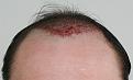 Click image for larger version

Name:	dk -immediate post-op front.jpg
Views:	340
Size:	87.8 KB
ID:	469286