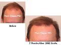 Click image for larger version

Name:	Hair Transplant Slides.263.jpg
Views:	304
Size:	57.3 KB
ID:	469309