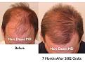 Click image for larger version

Name:	Hair Transplant Slides.266.jpg
Views:	422
Size:	79.0 KB
ID:	469310