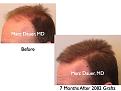 Click image for larger version

Name:	Hair Transplant Slides.264.jpg
Views:	304
Size:	58.4 KB
ID:	469311