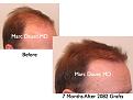 Click image for larger version

Name:	Hair Transplant Slides.265.jpg
Views:	296
Size:	58.5 KB
ID:	469312