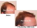 Click image for larger version

Name:	Hair Transplant Slides.265.jpg
Views:	388
Size:	58.5 KB
ID:	469312