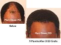 Click image for larger version

Name:	Hair Transplant Slides7.267.jpg
Views:	351
Size:	67.1 KB
ID:	469316