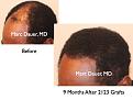 Click image for larger version

Name:	Hair Transplant Slides7.268.jpg
Views:	326
Size:	66.9 KB
ID:	469317
