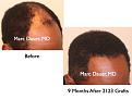 Click image for larger version

Name:	Hair Transplant Slides7.269.jpg
Views:	315
Size:	66.9 KB
ID:	469318