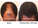 Click image for larger version

Name:	Hair Transplant Slides7.270.jpg
Views:	448
Size:	71.1 KB
ID:	469319