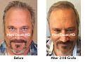 Click image for larger version

Name:	Hair Transplant Slides4.273.jpg
Views:	434
Size:	87.7 KB
ID:	469320