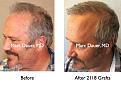 Click image for larger version

Name:	Hair Transplant Slides4.274.jpg
Views:	391
Size:	88.1 KB
ID:	469321