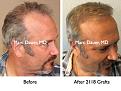 Click image for larger version

Name:	Hair Transplant Slides4.275.jpg
Views:	306
Size:	92.2 KB
ID:	469322