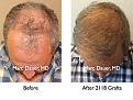 Click image for larger version

Name:	Hair Transplant Slides4.276.jpg
Views:	459
Size:	92.4 KB
ID:	469323