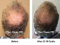 Click image for larger version

Name:	Hair Transplant Slides4.277.jpg
Views:	352
Size:	94.7 KB
ID:	469324