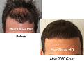 Click image for larger version

Name:	Hair Transplant Slides9.281.jpg
Views:	469
Size:	74.6 KB
ID:	469341