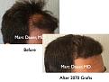 Click image for larger version

Name:	Hair Transplant Slides9.280.jpg
Views:	805
Size:	73.5 KB
ID:	469342