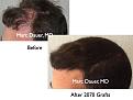 Click image for larger version

Name:	Hair Transplant Slides9.279.jpg
Views:	662
Size:	70.2 KB
ID:	469343