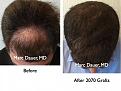 Click image for larger version

Name:	Hair Transplant Slides9.278.jpg
Views:	449
Size:	95.1 KB
ID:	469344