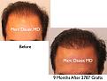 Click image for larger version

Name:	Hair Transplant Slides1.282.jpg
Views:	333
Size:	65.1 KB
ID:	469359